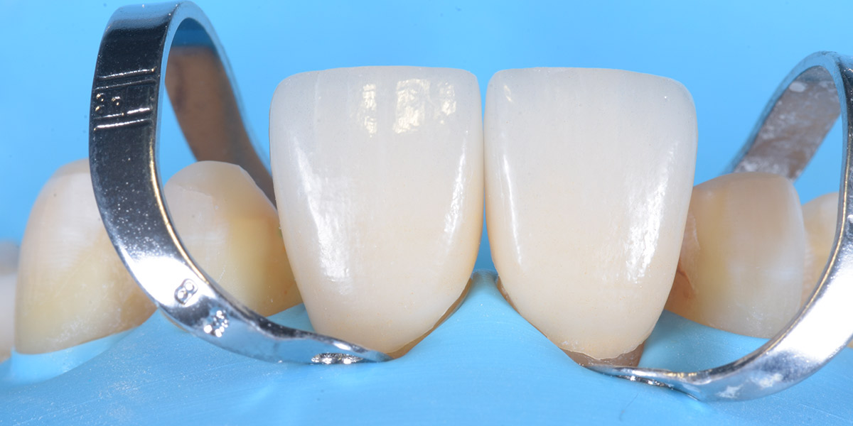 Faccette dentali Faccette Dentali Cementazione 1 Pieroni