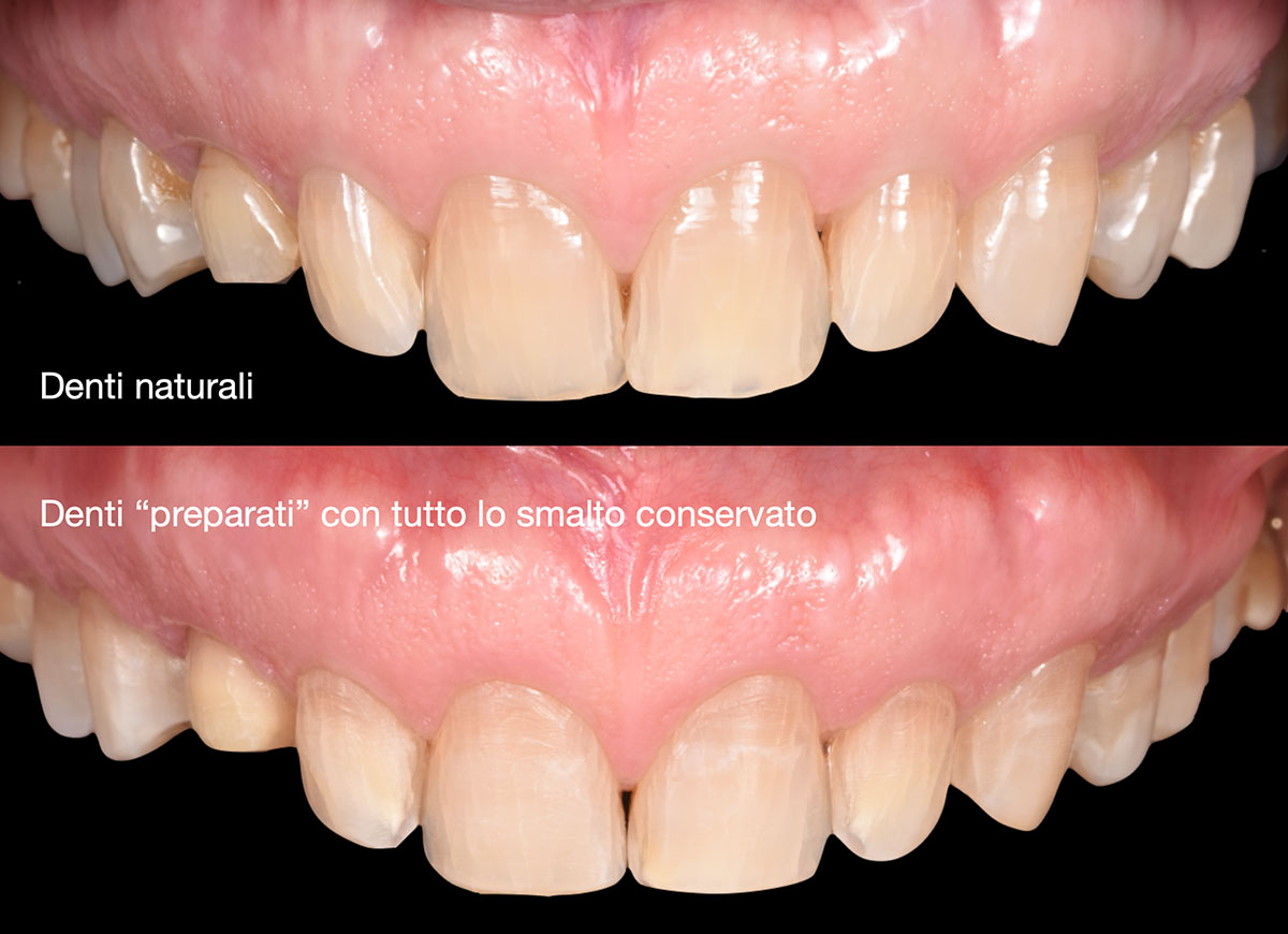 Faccette dentali Faccette Dentali Preparazione E Impronte Pieroni