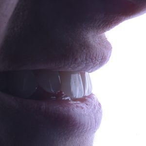 Domande e falsi miti sulle faccette dentali Faccette Dentali Risultato 2 Pieroni 300x300