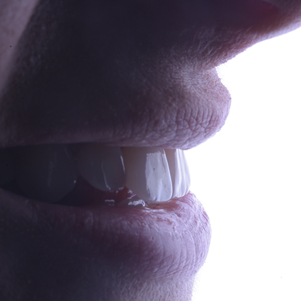 Faccette dentali Faccette Dentali Risultato 2 Pieroni