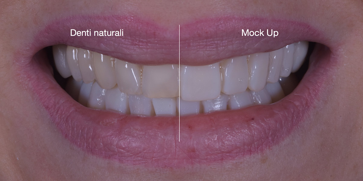 Faccette dentali Faccette Dentali Studio Caso Mockup 4 Pieroni