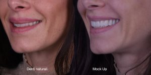 Migliora il tuo sorriso con le faccette a Milano Faccette Dentali Studio Caso Mockup 5 Pieroni 300x150