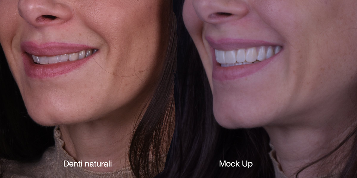 Faccette dentali Faccette Dentali Studio Caso Mockup 5 Pieroni