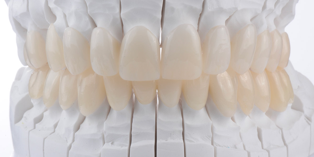 Faccette dentali Faccette Dentali Studio Caso Mockup 6 Pieroni