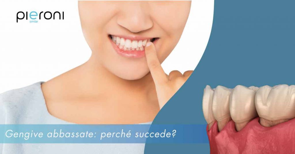Gengive abbassate: perché succede? gengive abbassate||