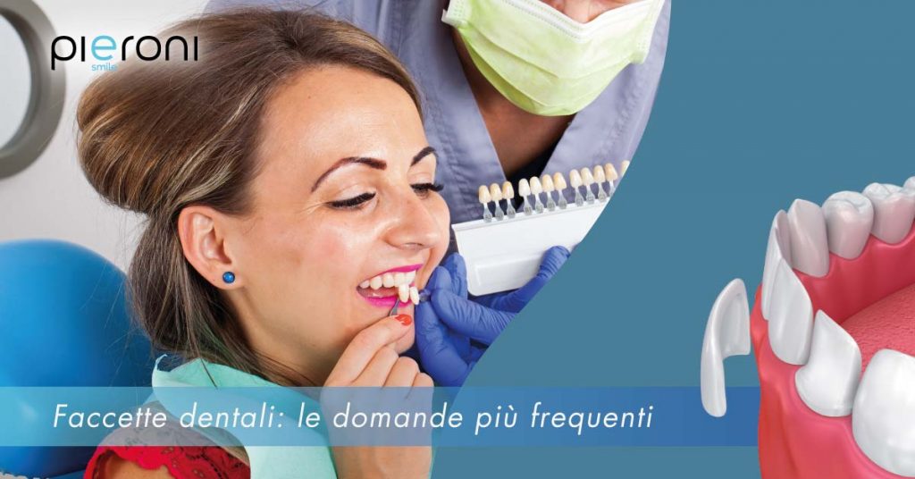 Faccette dentali: le domande più frequenti news_faccettedentali