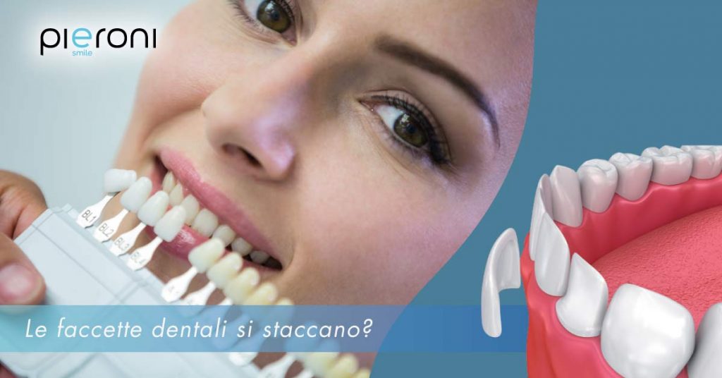 Le faccette dentali si staccano? faccette-dentali-che-si-staccano