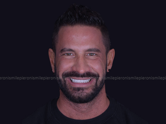Prima e dopo Pieroni Caso2 Dopo