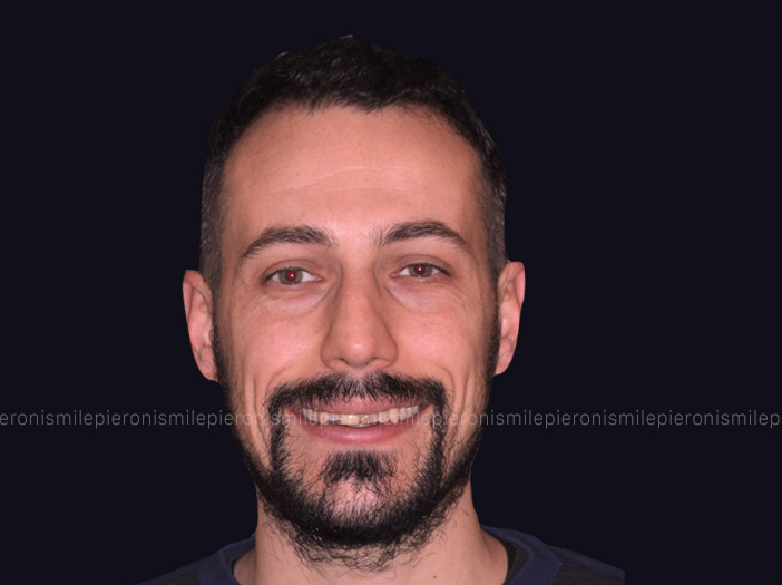 Prima e dopo Pieroni Caso5