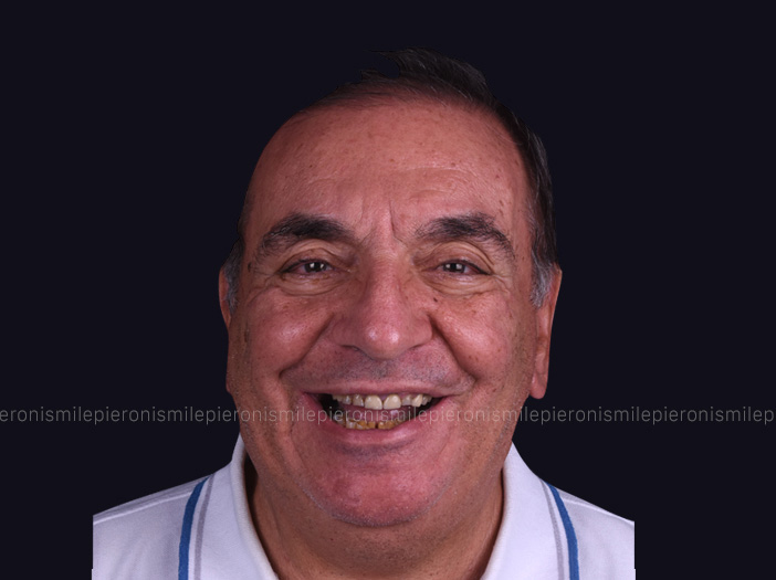 Prima e dopo Pieroni Caso6