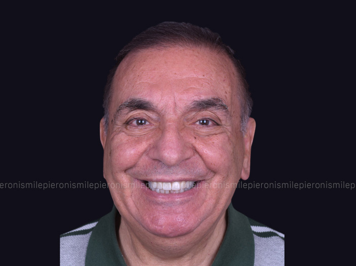 Prima e dopo Pieroni Caso6 Dopo