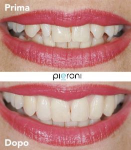 Faccette estetiche: percorso e durata Come Avere Un Sorriso Smagliante2 E1569835881635 263x300
