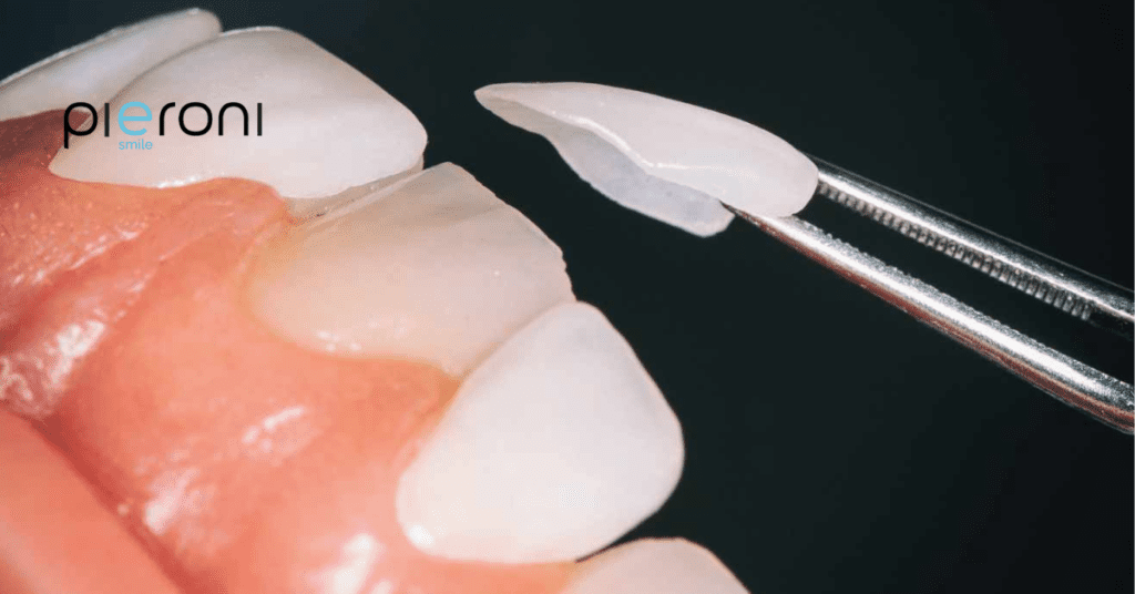 Domande e falsi miti sulle faccette dentali domande faccette dentali