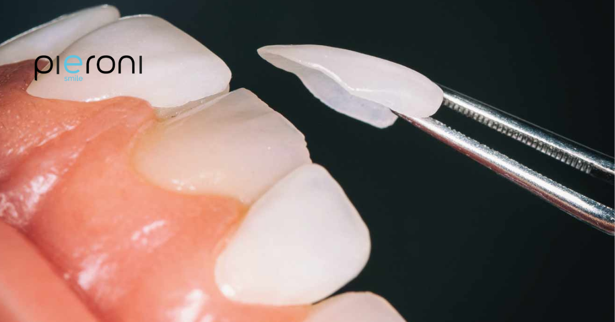 domande faccette dentali