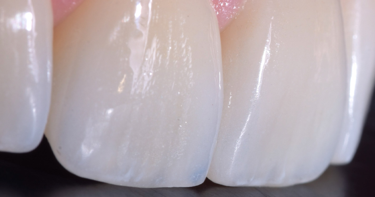 Faccette dentali Faccette Dentali Pieroni