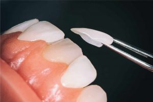 Le faccette dentali si staccano? faccette-dentali-si-staccano