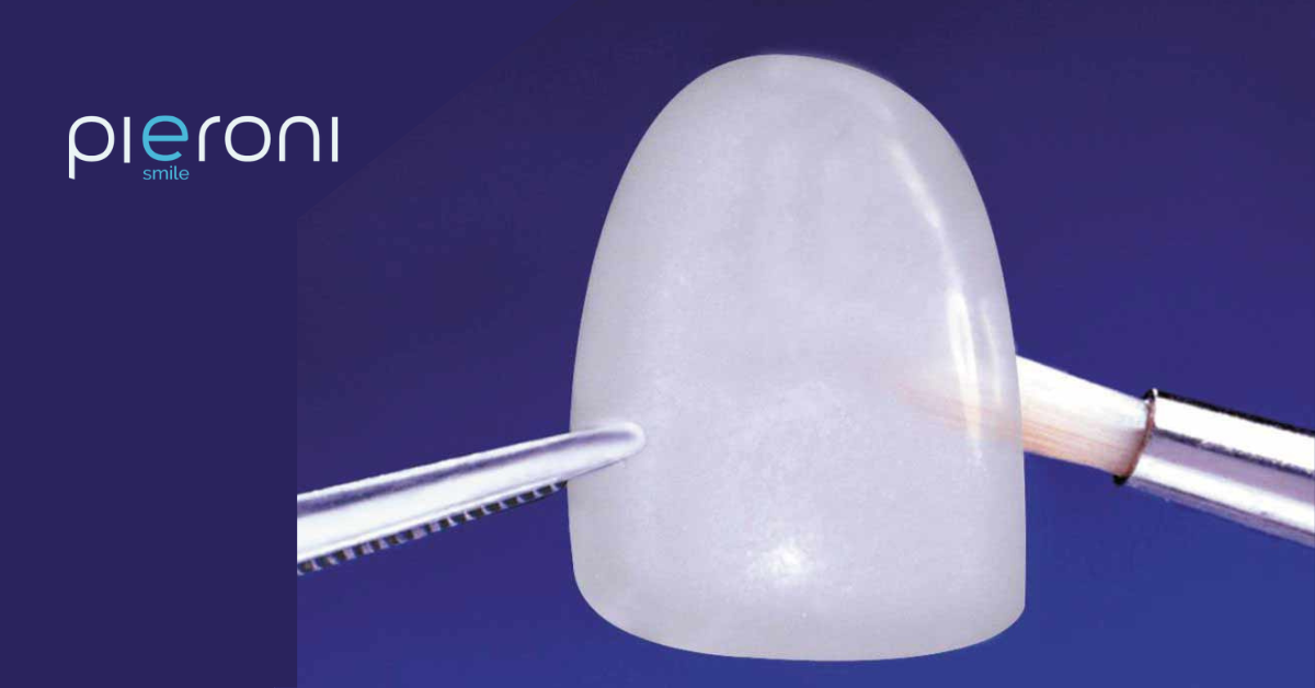 faccette estetiche